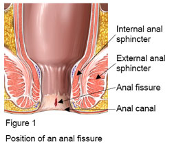Anal fissure diagram